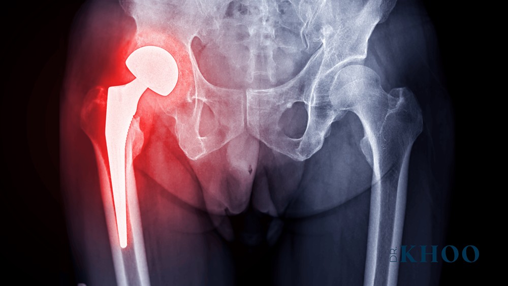 Sydney’s Top Hip Surgeon: Unrivalled Orthopaedic Excellence & Care